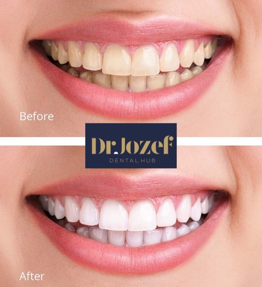 clinica albire dentara brasov